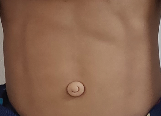 Loss of subcutaneous tissue over abdomen.